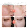 Anti Stains Acne Treatment Cream Scar Blackhead Face Cream Shrink Pores Whitening Skin Care Face Cream Korean Cosmetics - 50G